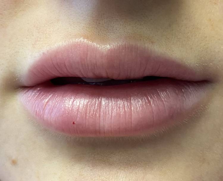 Lip filler After 2 weeks